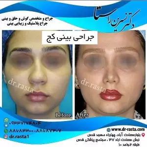 جراحی بینی کج