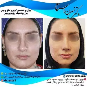 جراحی پلاستیک بینی زنانه