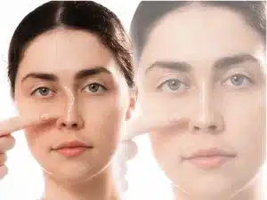 جراحی بینی کج