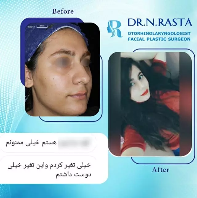 رضایت بعد از عمل بینی- دکتر نسرین راستا